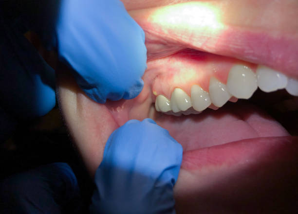 Best Knocked-Out Tooth (Avulsed Tooth) Treatment in Homestead, PA